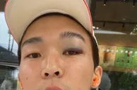 肿成熊猫眼了????记者：元敏诚被撞到眼角，不得不休息两天