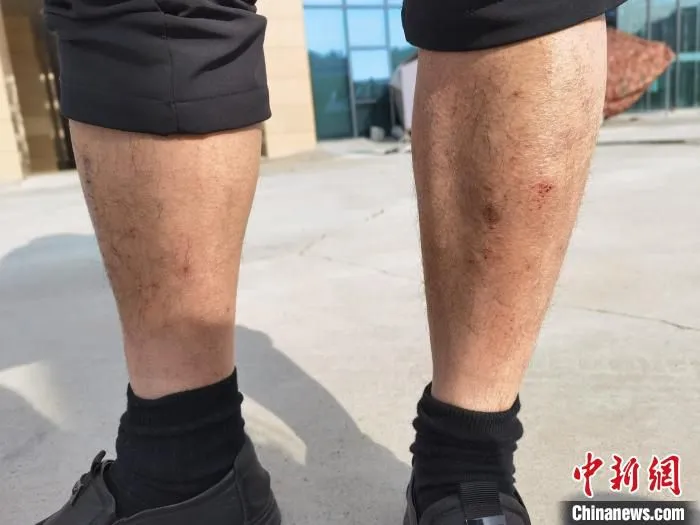 图为消杀专班成员因长期接触消毒水，长满红疹子的小腿。　祁增蓓 摄