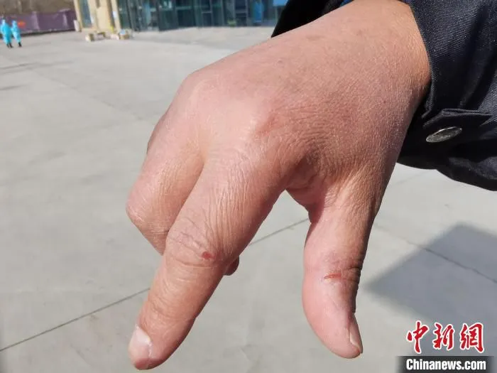 图为长期与消毒水接触，李寿江的手产生裂口。　祁增蓓 摄