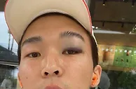 肿成熊猫眼了????记者：元敏诚被撞到眼角，不得不休息两天